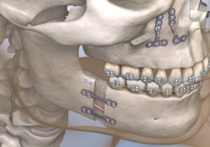 shirley jaw surgery