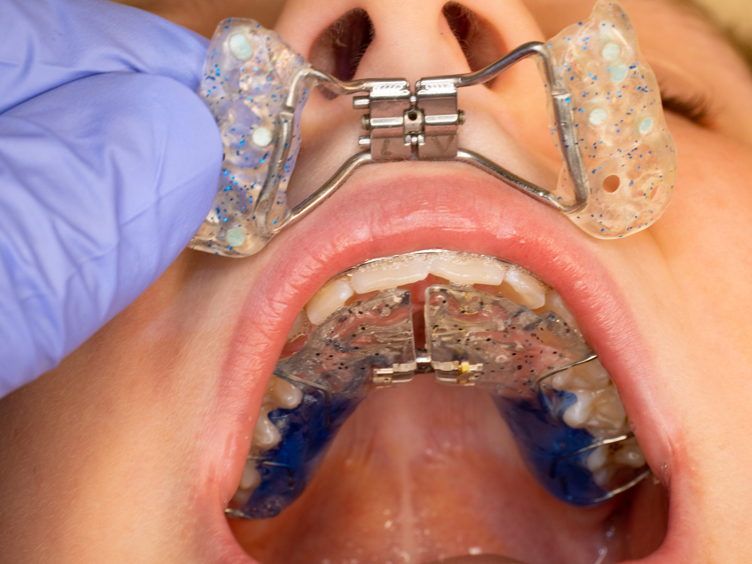 shirley phased orthodontics