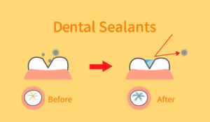 shirley dental sealants