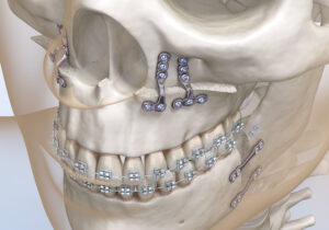 shirley jaw surgery