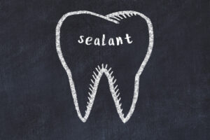 shirley dental sealants