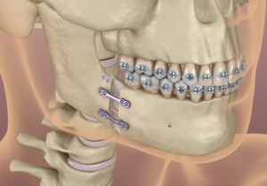 shirley corrective jaw surgery