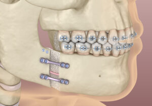 shirley jaw surgery