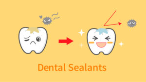 shirley dental sealants