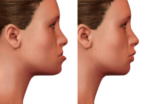 shirley jaw surgery