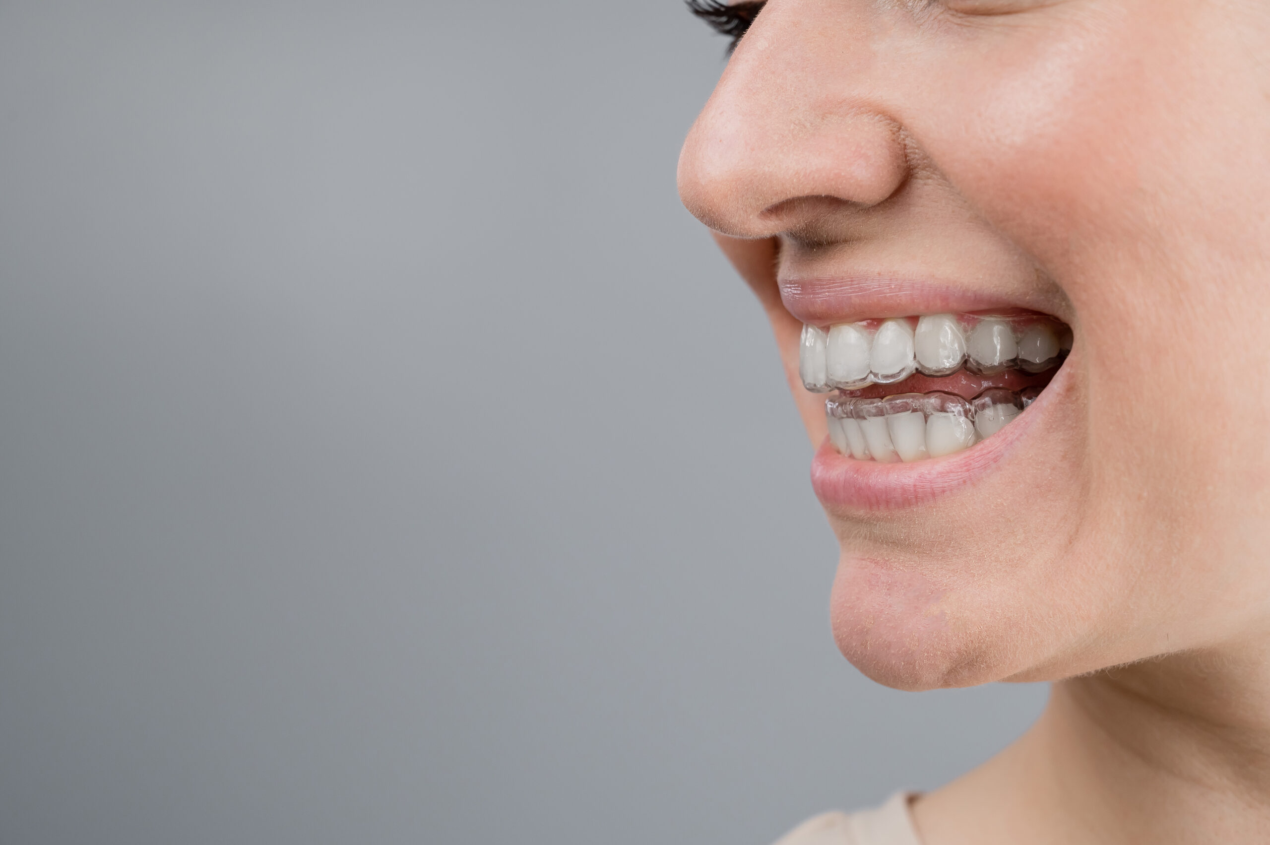 Closeup of woman wearing clear aligners