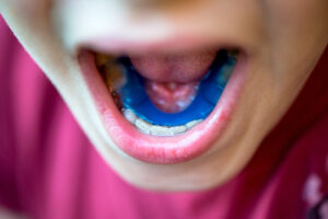 Dental Blue Removable Brace or Retainer for Teeth in the Boys Mouth, Orthodontic concept