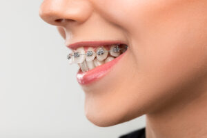 Shirley Orthodontics offers jaw surgery to patients who need it
