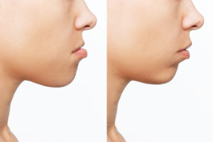Shirley, NY ortho offers jaw surgery when necessary 
