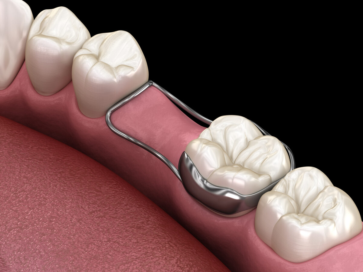 Reduce Orthodontic Treatment Time With Space Maintainers