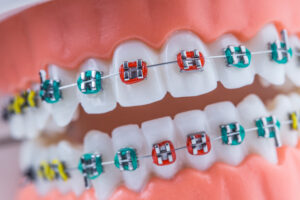 Shirley, NY, dentist offers invisalign, braces, or ceramic braces 