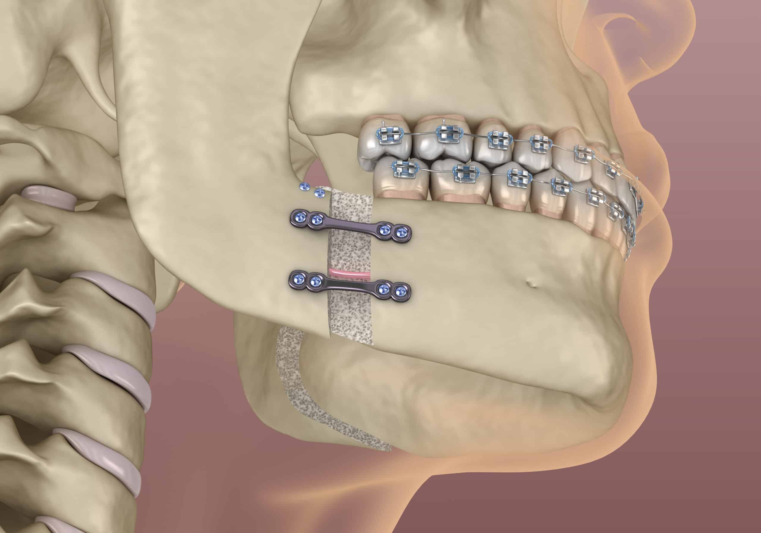 shirley jaw surgery