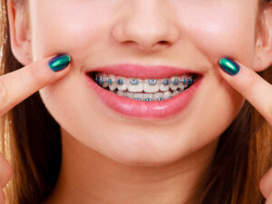 shirley braces