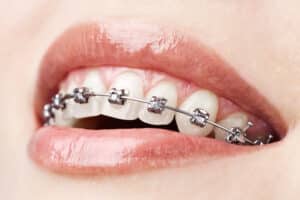 shirley braces