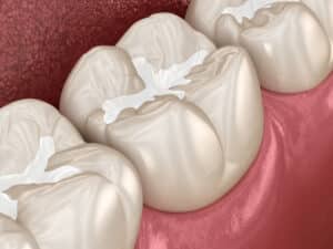 shirley dental fillings